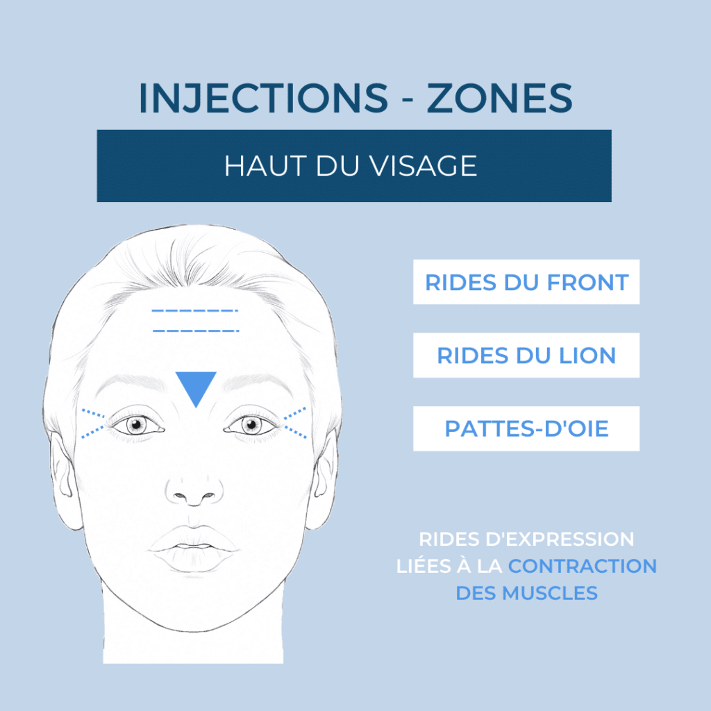injection haut du visage elase paris